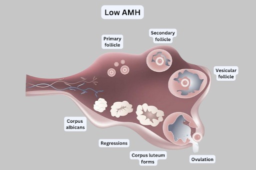 Low AMH Level