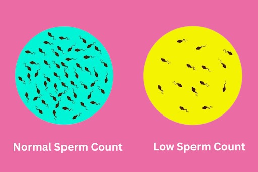 Oligospermia - Low Sperm Count