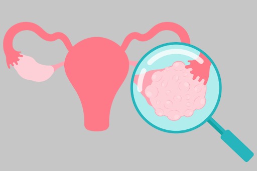 polycystic ovary syndrome