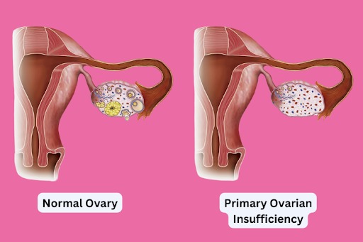 Primary Ovarian Insufficiency