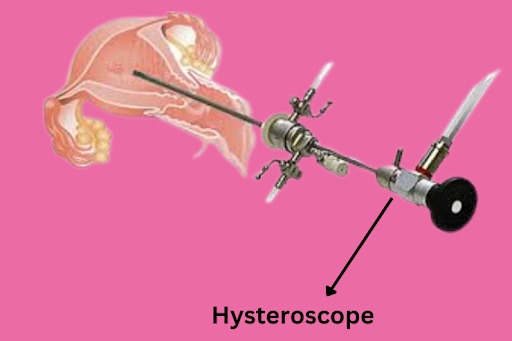 Hysteroscopy