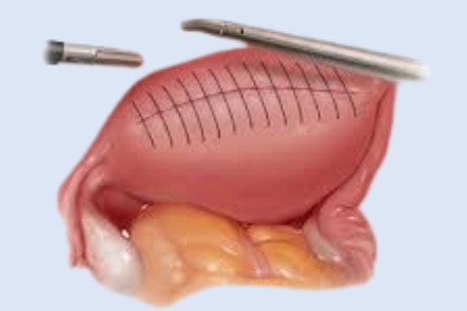 Laparoscopic Adenomyomectomy