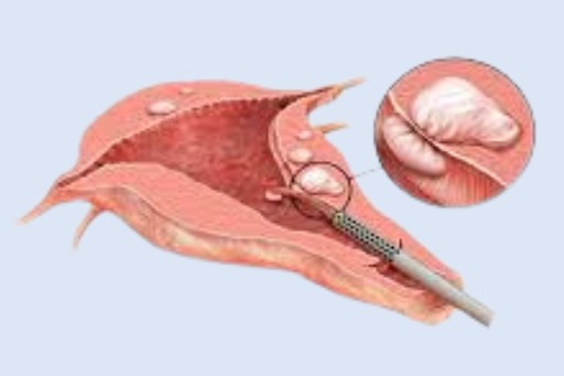 Laparoscopic Myomectomy