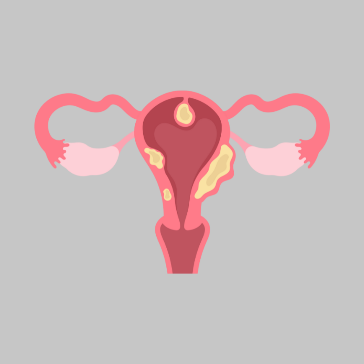 Uterine Fibroids