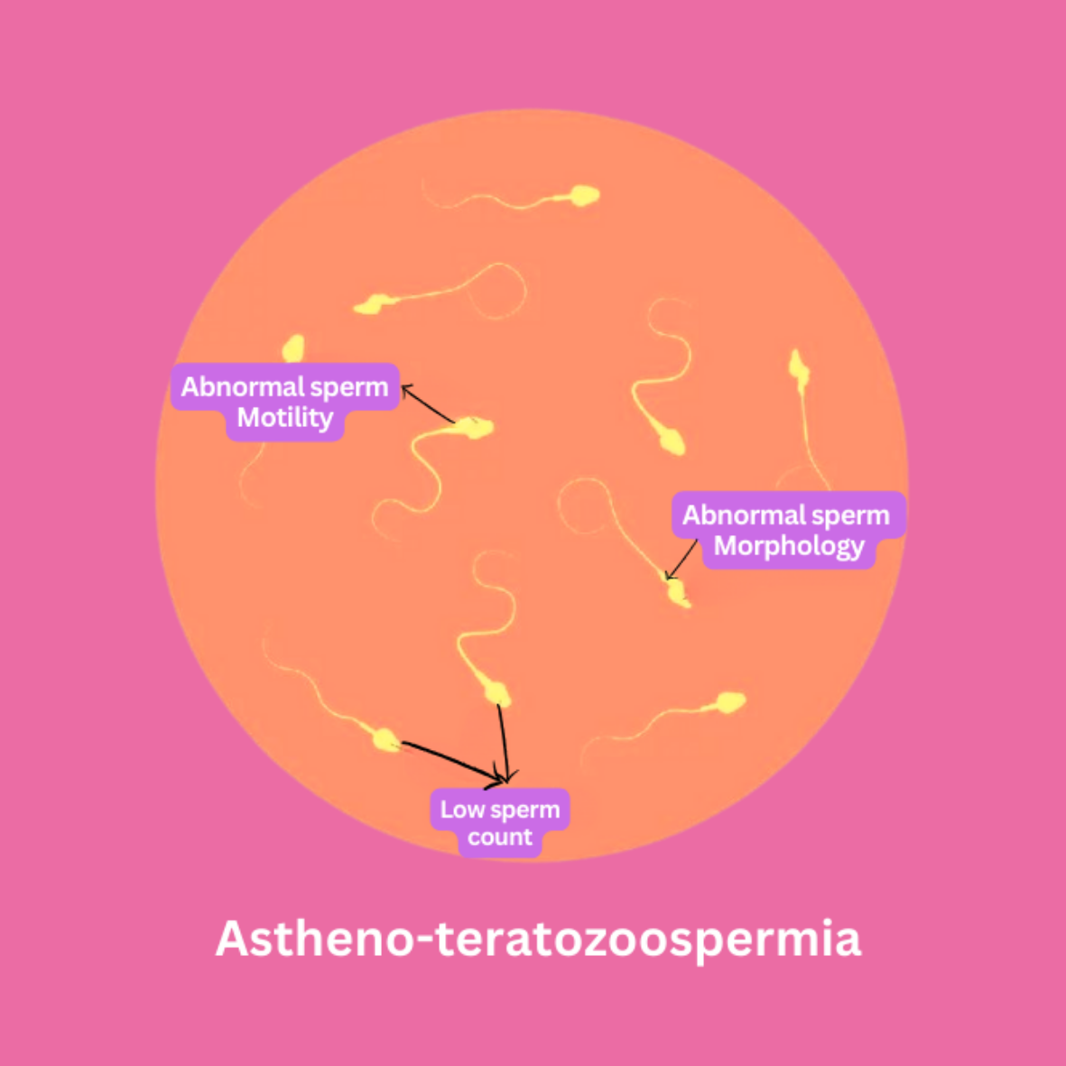 Astheno-teratozoospermia