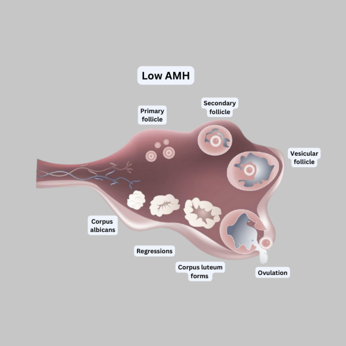 Low AMH Level