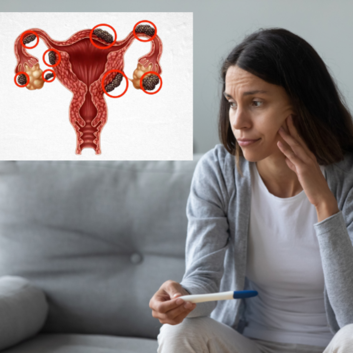 Endometriosis & Infertility