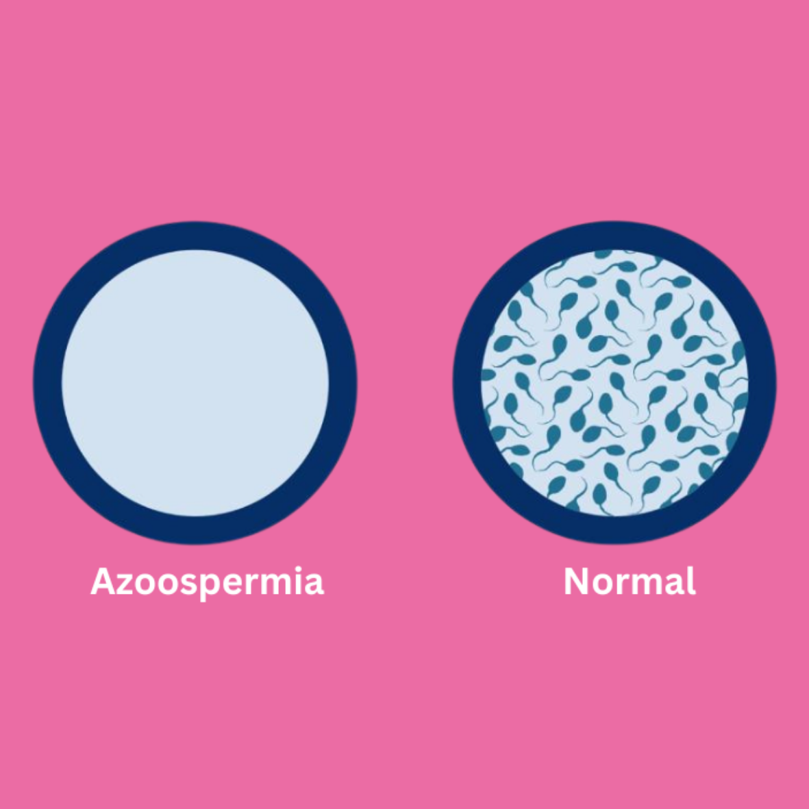 Zero sperm count - Azoospermia