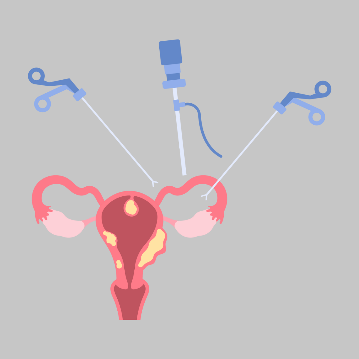 Advanced Laparoscopy for Endometriosis