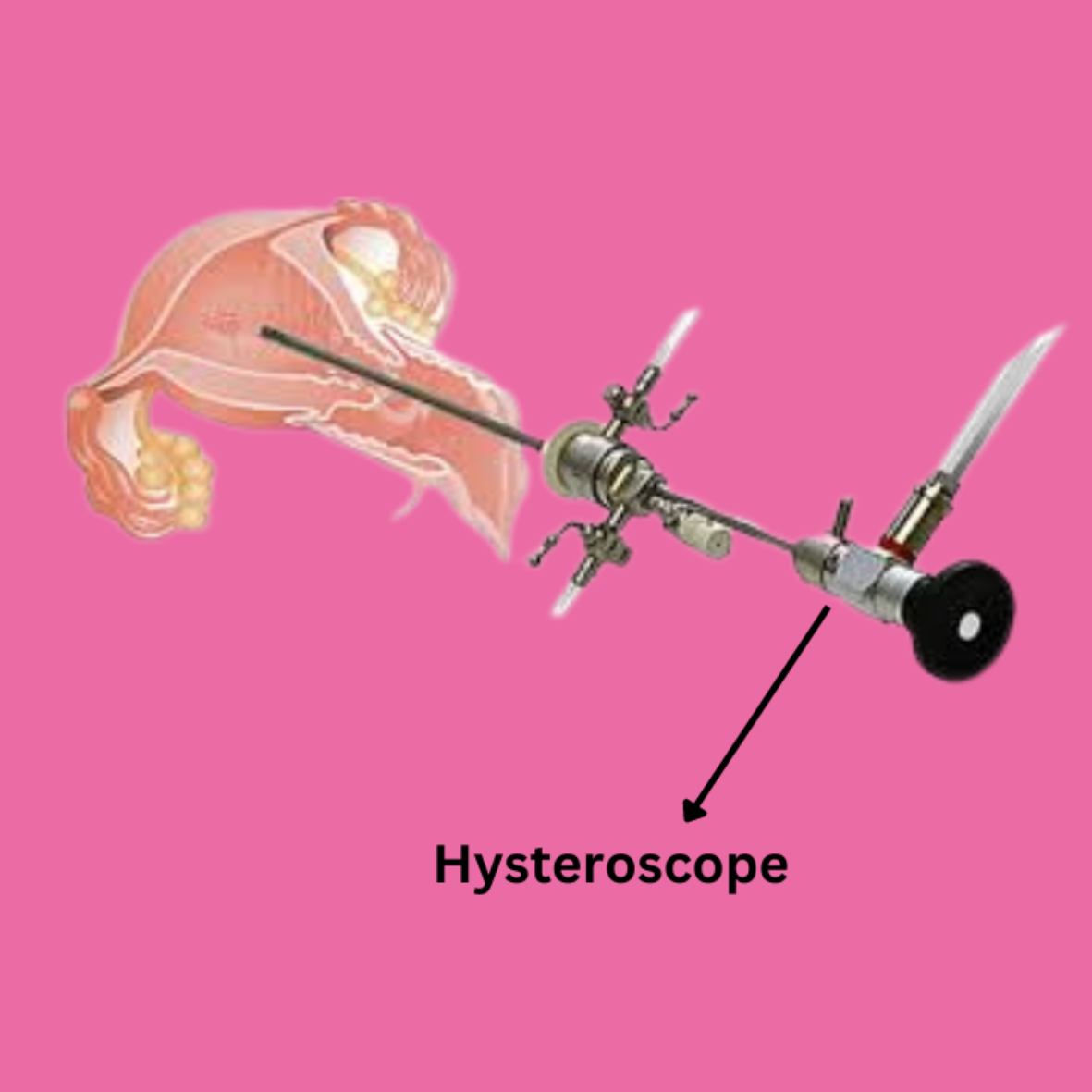 Hysteroscopy