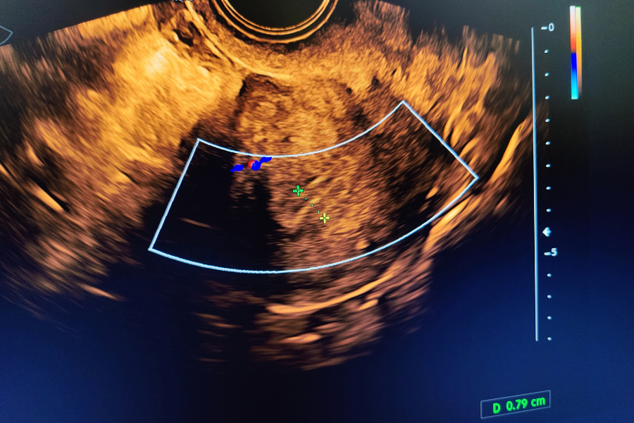 Endometrium & Infertility