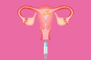 Ovarian hyperstimulation