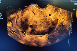 USG Adenomyosis