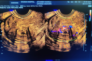 endometrial polyp