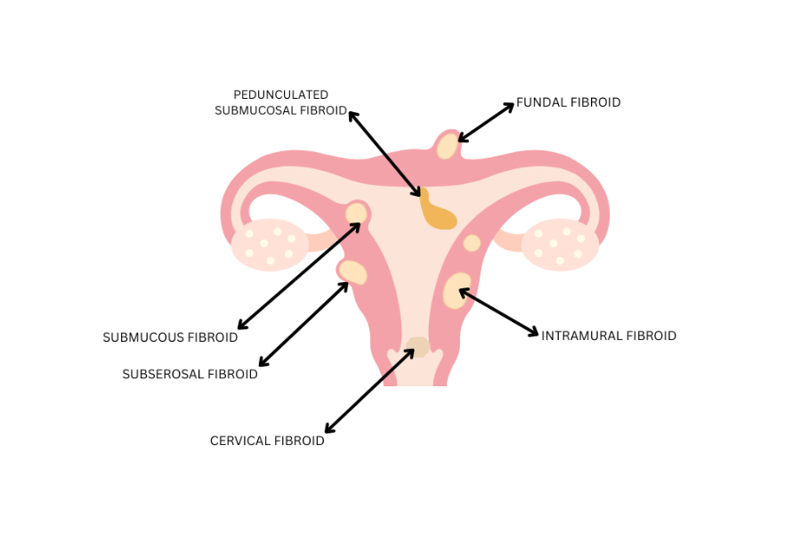 fibroid