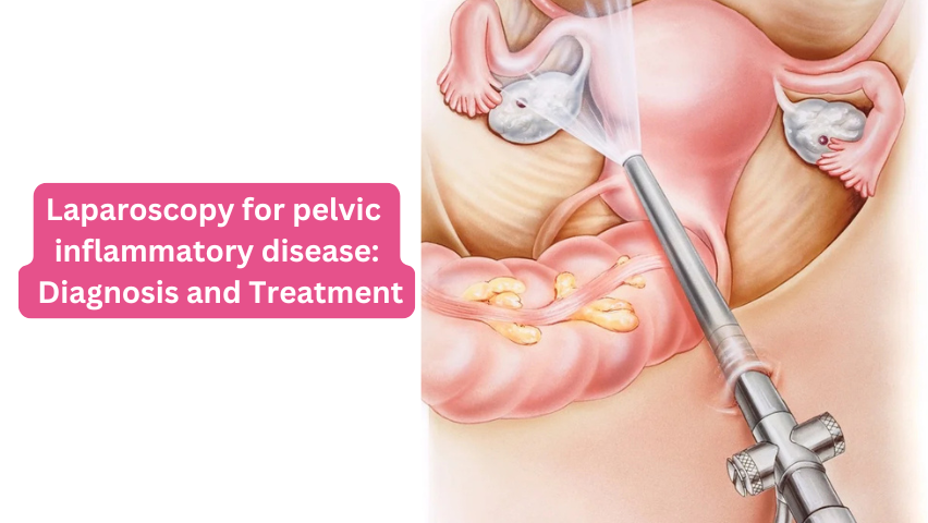 Laparoscopy for pelvic inflammatory disease: Diagnosis and Treatment