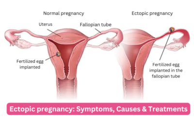 Ectopic pregnancy: Symptoms, Causes & Treatments