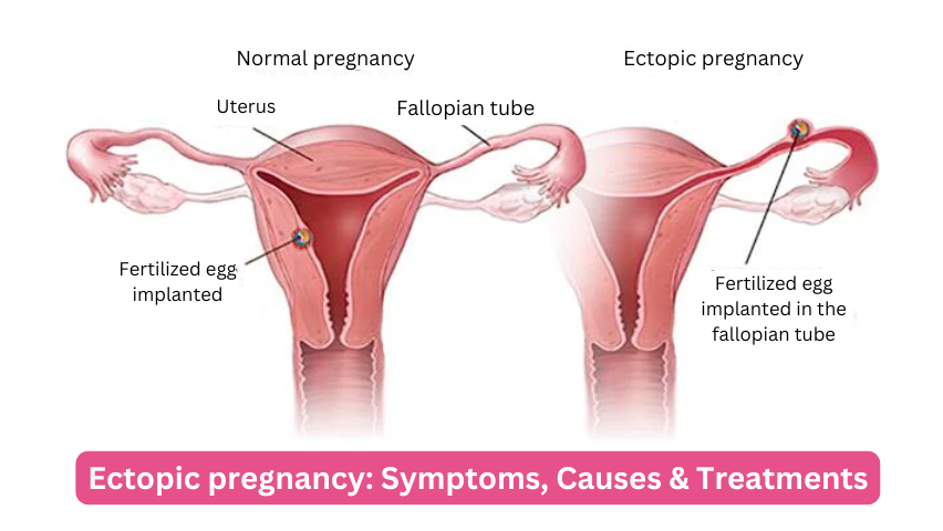 Ectopic pregnancy: Symptoms, Causes & Treatments