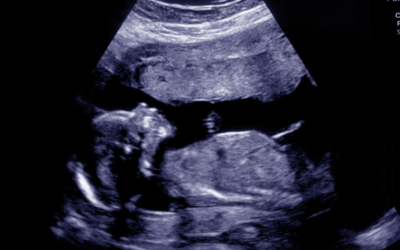 Understanding the fetal anatomy scan: What to look for?