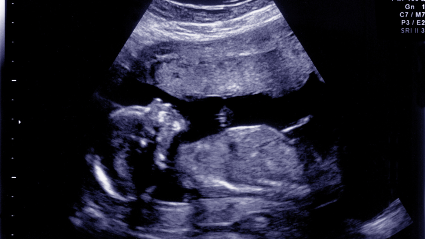 Understanding the fetal anatomy scan: What to look for?