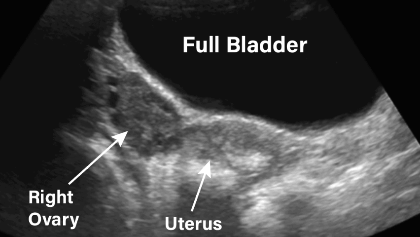 Pelvic ultrasound