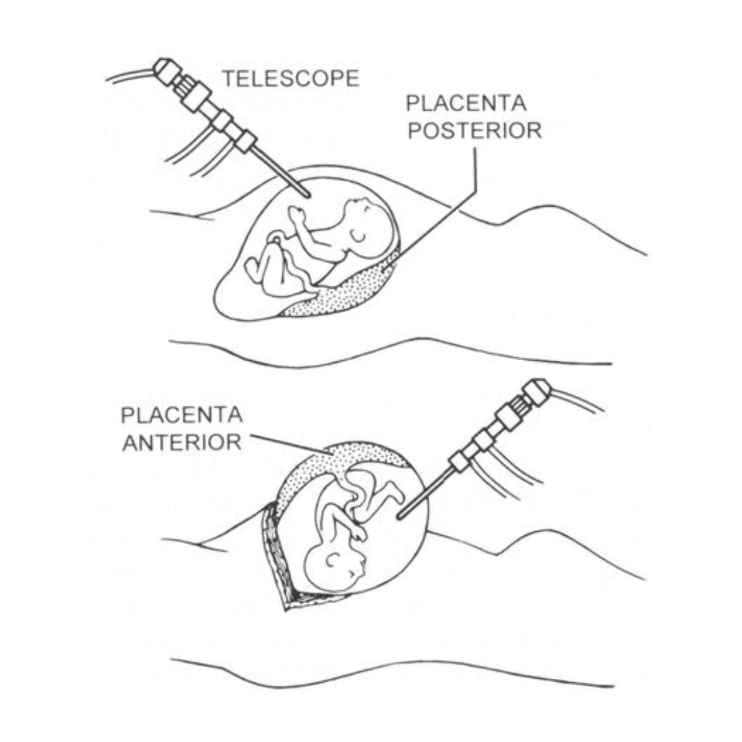 Minimally-Invasive Fetal Surgery